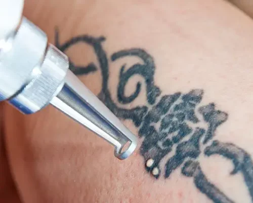 détatouage par laser diode