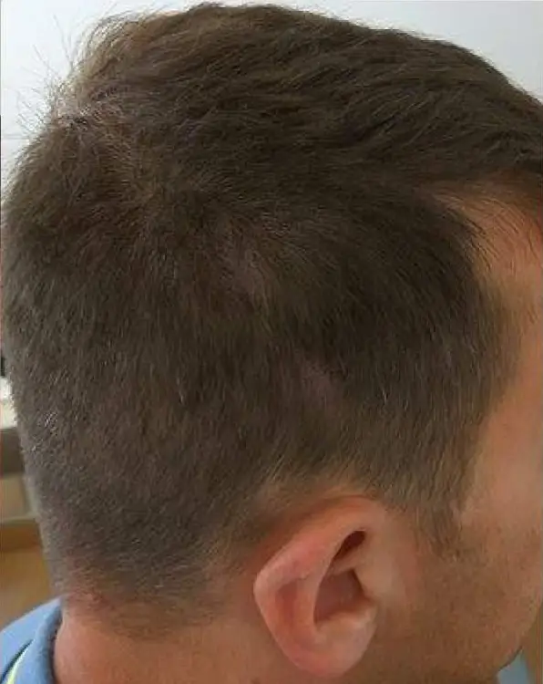 Scalp homme recouvert après tricopigmentation