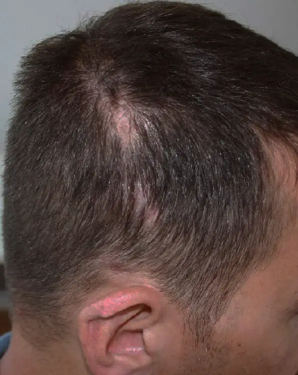 scalp homme visible avant tricopigmentation