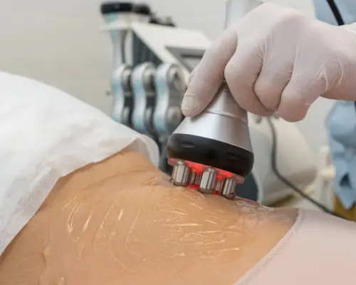 lipocavitation & radiofréquence : ventre