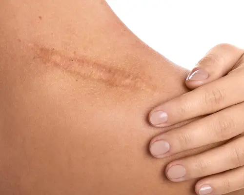 soins du corps_ traitement des cicatrices & vergetures