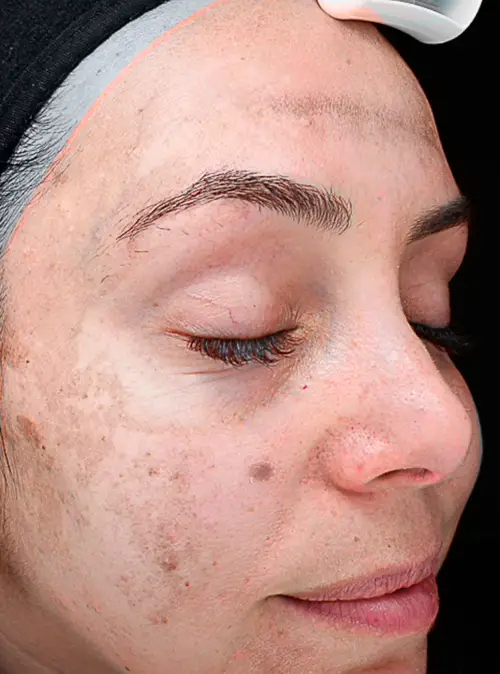 peeling peau acnéique avant