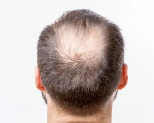 perte de cheveux- calvitie et alopécie