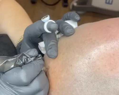 traitement capillaire tricopigmentation soin de l'alopécie androgénétique