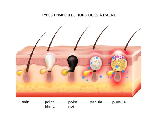 Types d'imperfections dues à l'acné