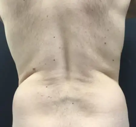 État de la graisse dorsale avant la cryolipolyse