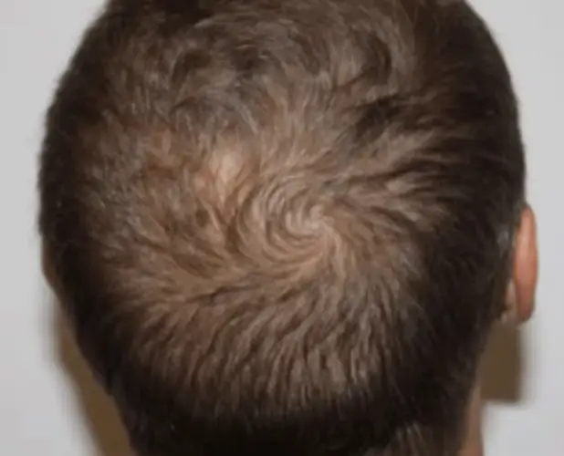 Aperçu de l'état de cheveux sur le crâne après hydrafacial keravive