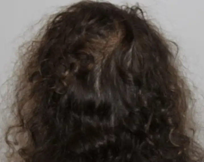 Aperçu de l'état des cheveux après hydrafacial keravive
