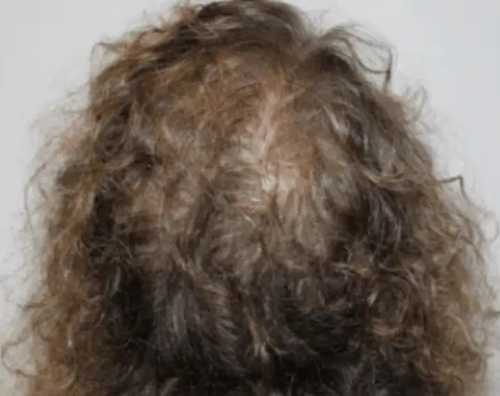 Aperçu de l'état des cheveux avant hydrafacial keravive