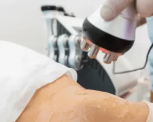 lipocavitation et radiofréquence