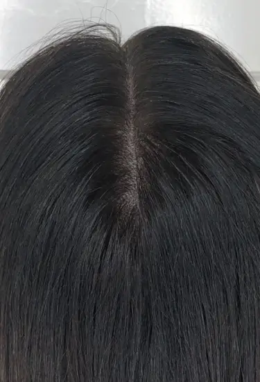 Amincissement de la raie centrale des cheveux après tricopigmentation