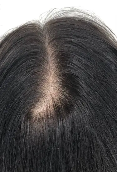 État de la raie centrale des cheveux avant ticopigmentation