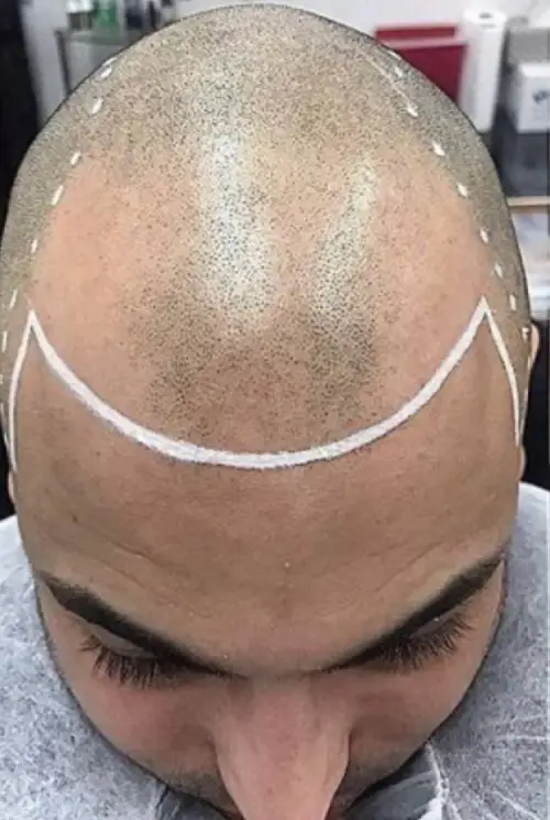 État capillaire du crâne rasé avant tricopigmentation