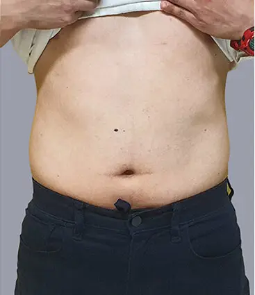 État graisse abdominale avant traitement 6 en 1