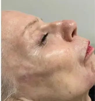 état du visage lissé et repulpé 6 mois après le traitement liftant HIFU