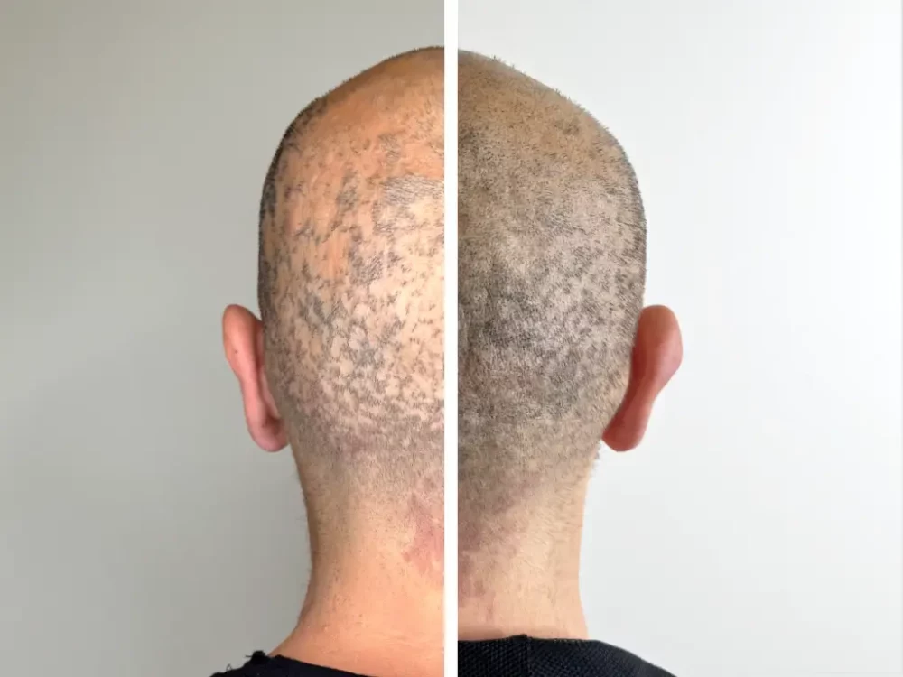 tricopigmentation - pigmentation solution à la calvitie et alopécie androgénétique