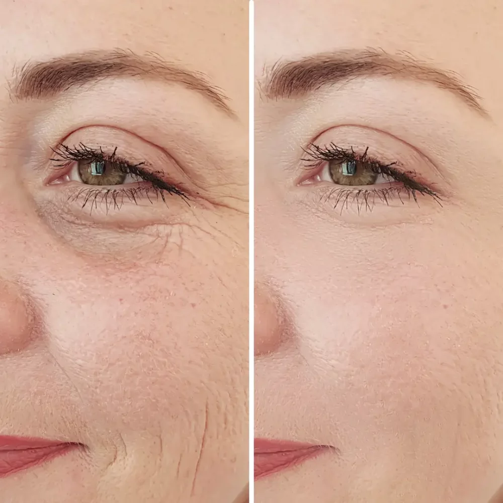Avant après peeling PRX-T33 anti ride éclat