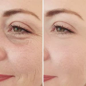 Avant après peeling PRX-T33 anti ride éclat
