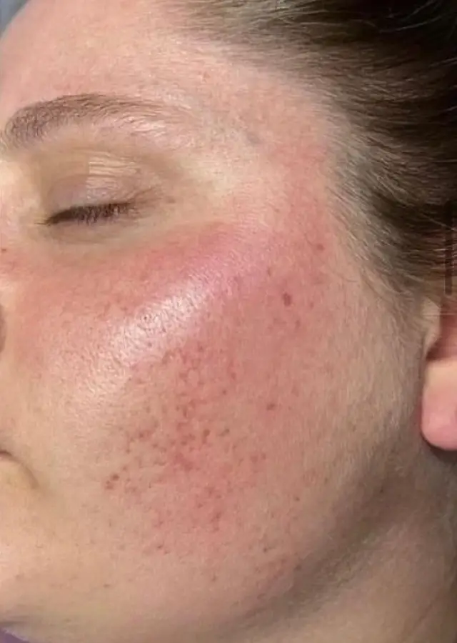 état de la peau après traitement peeling aux algues : disparition de l'acné et des cicatrices