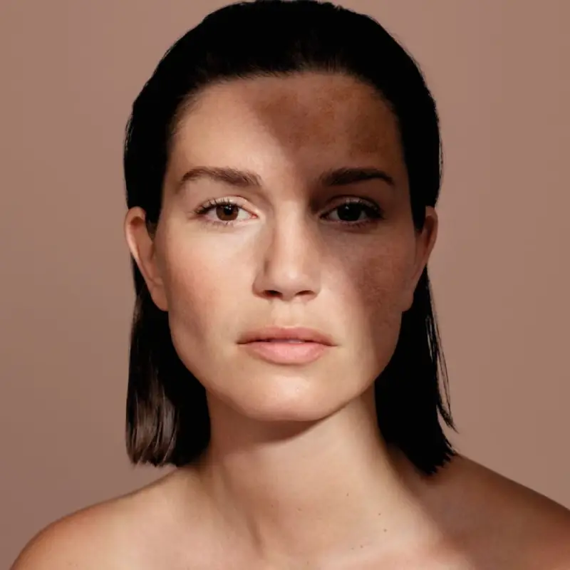 hyperpigmentation soin dermatologique du melasma