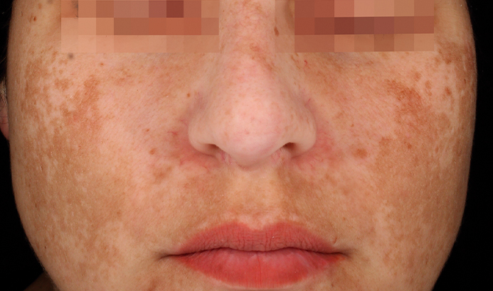 Avant après Cosmelan Peel contre melasma (C) : avant traitement, présence de taches de melasma sur les joues et le nez