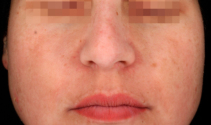 Avant après Cosmelan Peel contre melasma (C) : après traitement, disparition de taches de melasma sur les joues et le nez