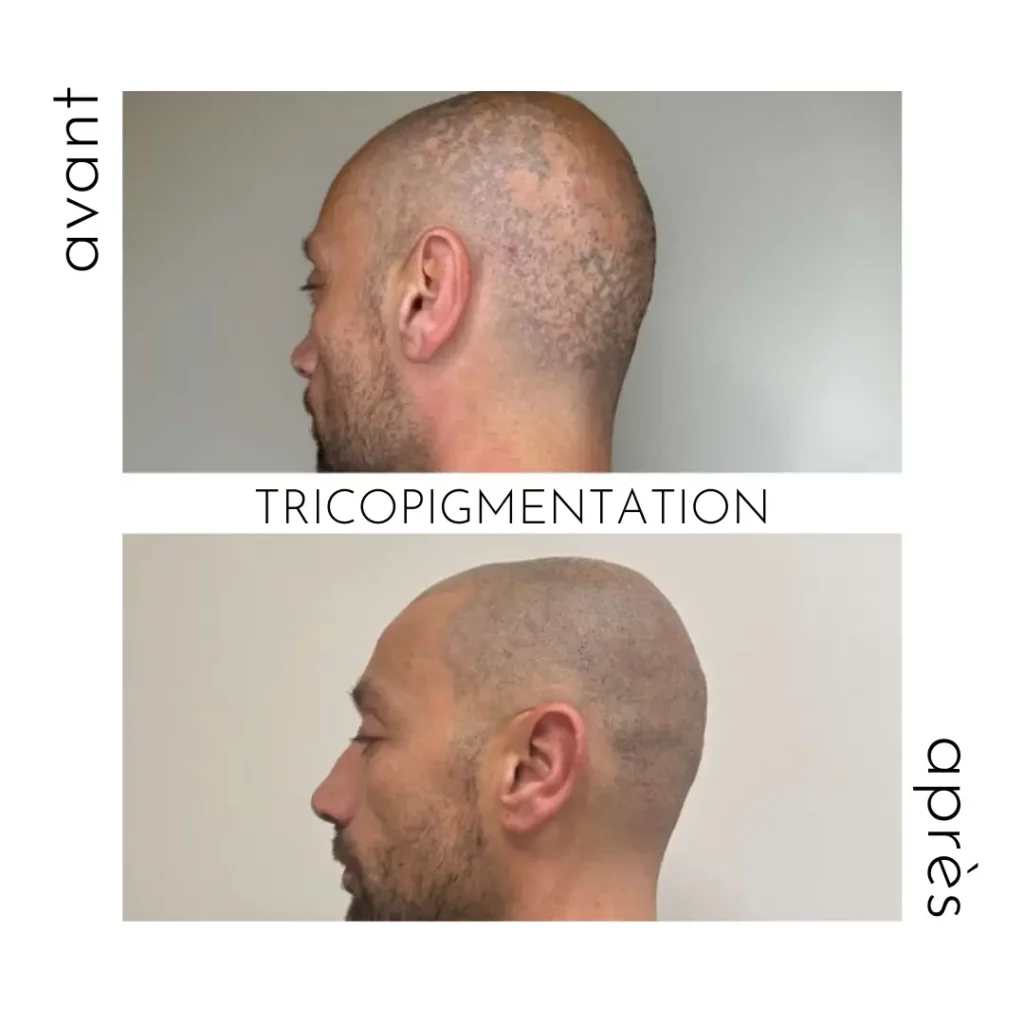 tricopigmentation soin anti contre la perte de cheveux