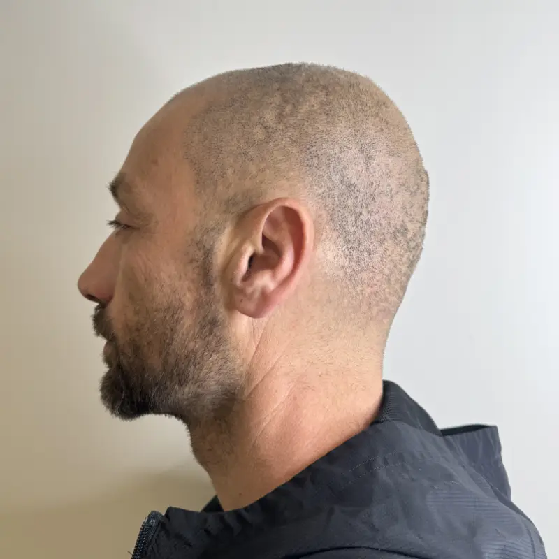 tricopigmentation S8 - après traitement anti calvitie