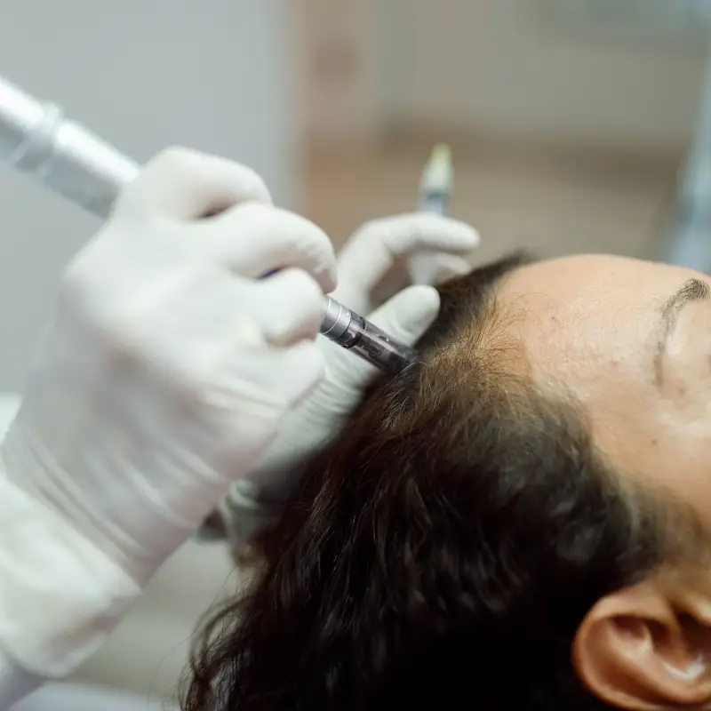 Microneedling capillaire traitement de stimulation de pousse des cheveux