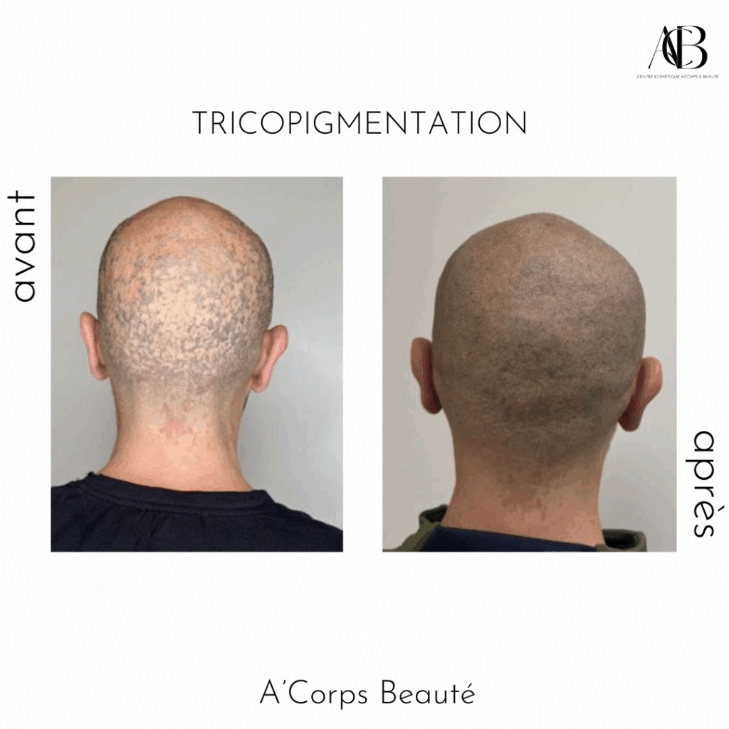 tricopigmentation traitement contre la pelade perte de cheveux homme