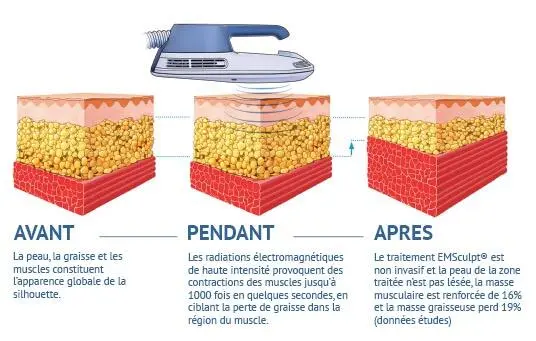 Body Sculpt par electrostimulation fonctionnement