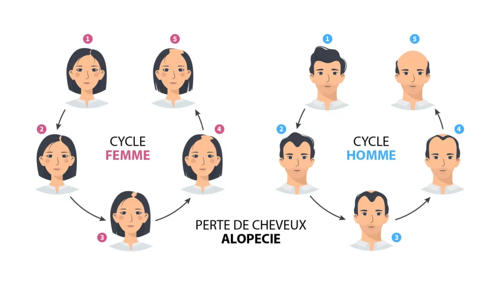 phases de l'alopécie - perte de cheveux homme et femme