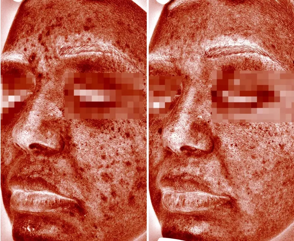 COSMELAN peel traitement acné vue taches