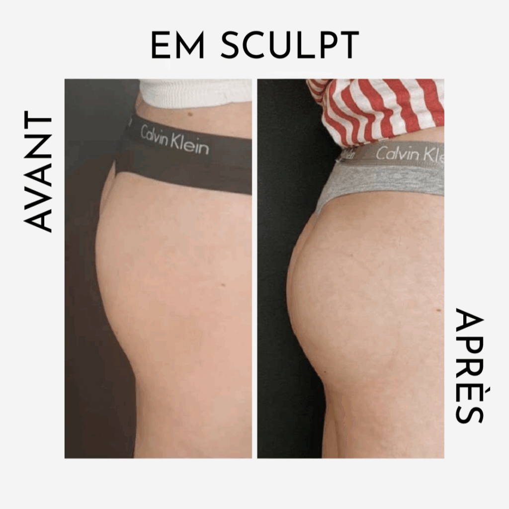 EM Sculpt pour préparer son corps pour l'été