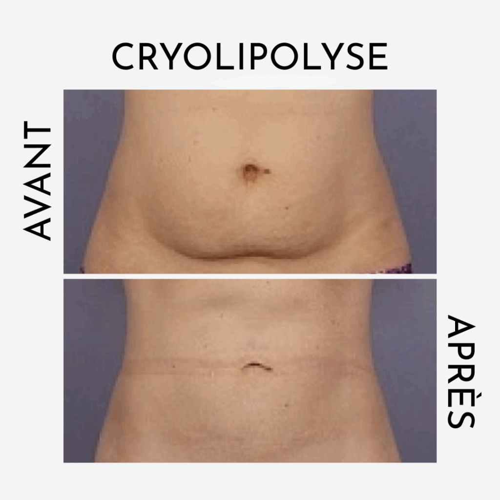 cryolipolyse pour préparer son corps pour l'été