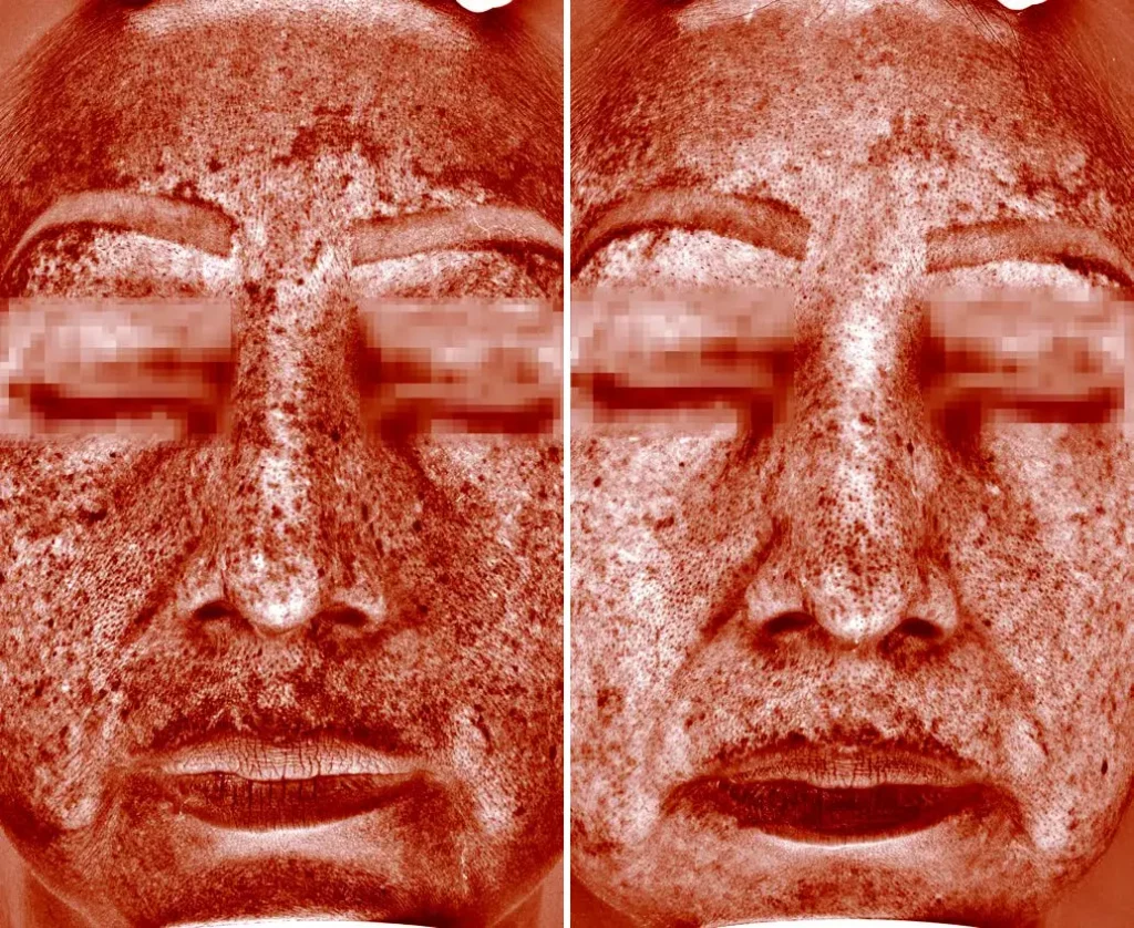 Peeling cosmelan avant après taches pigmentaires