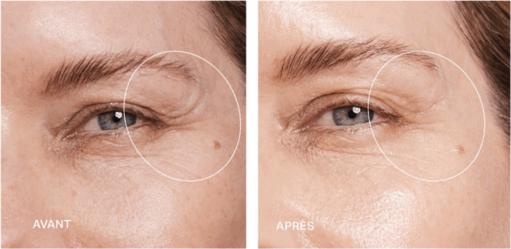 avant après soin booster hydrafacial hydrafillic