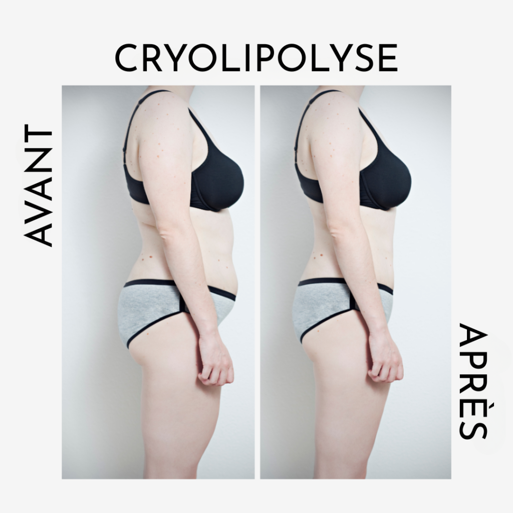 avant/après cryolipolyse médicale a'corps beauté nancy metz