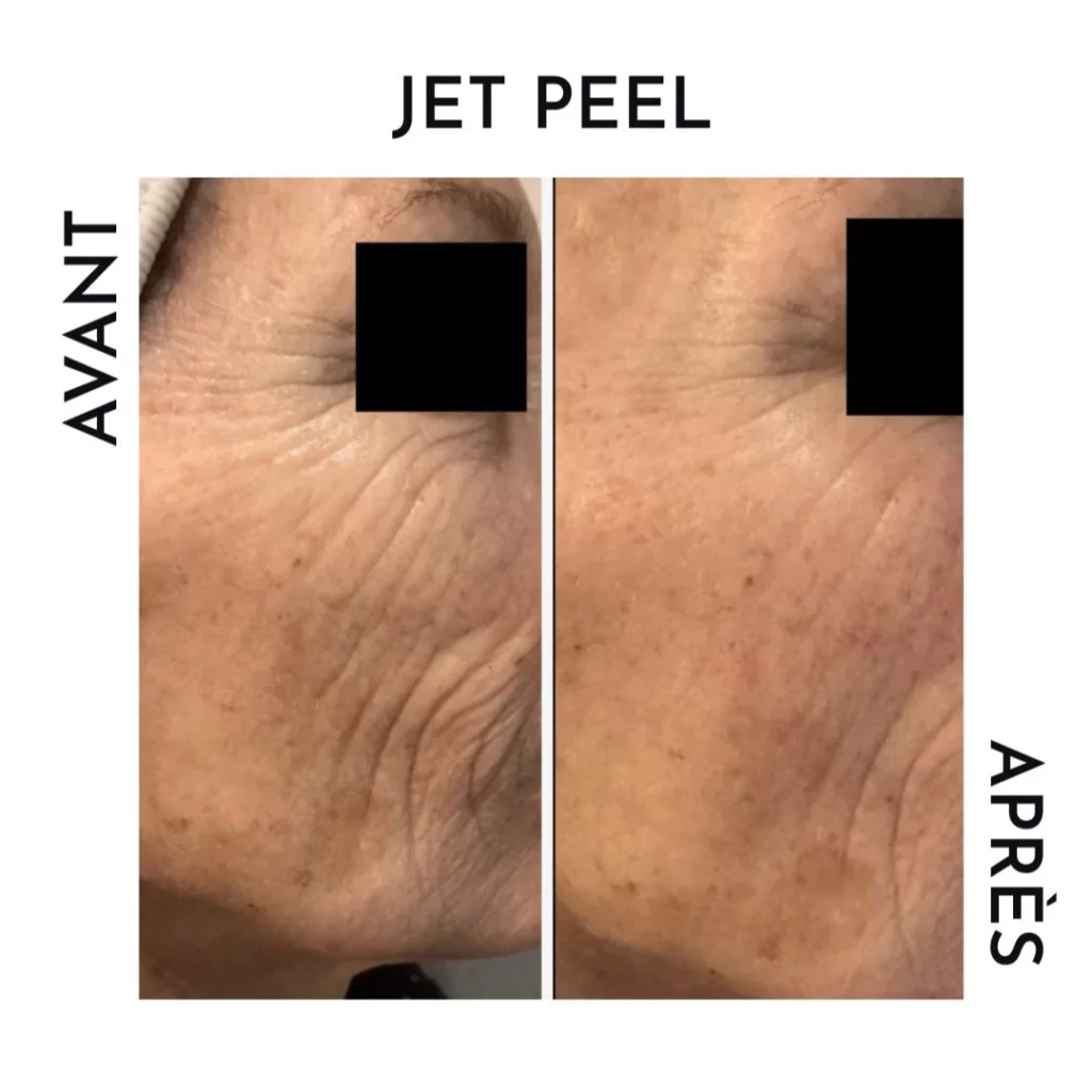 soins visage - avant après jet peel