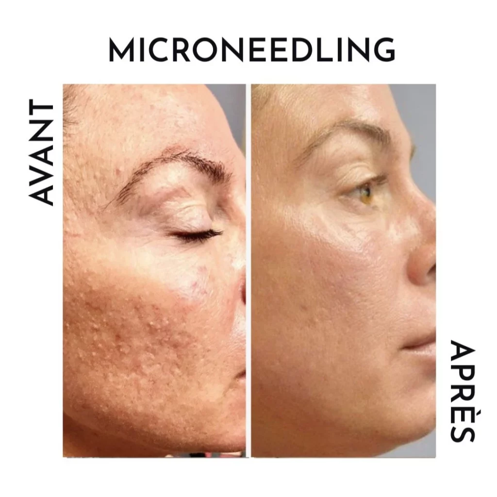 soins visage - avant après microneedling