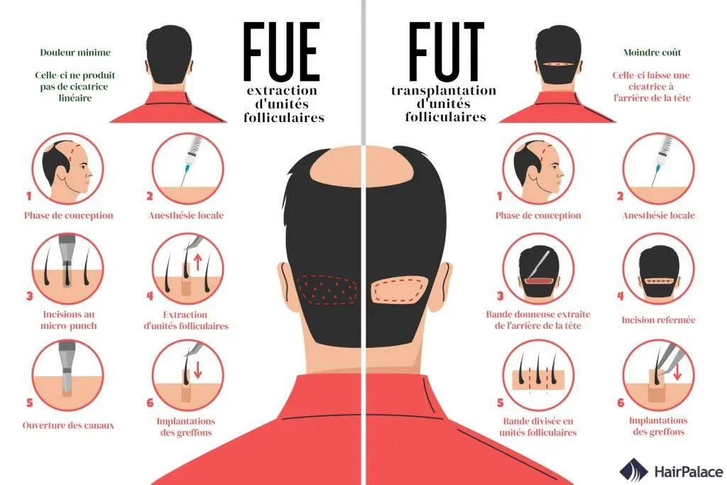 perte de cheveux - techniques de greffe capillaire FUT et FUE - a'corps beauté