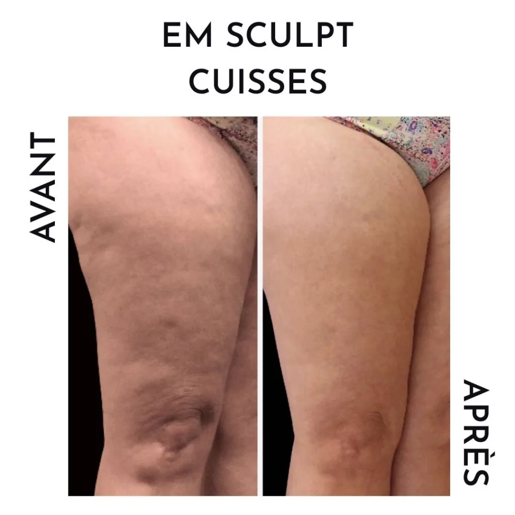 résultat avant/après em sculpt cuisses