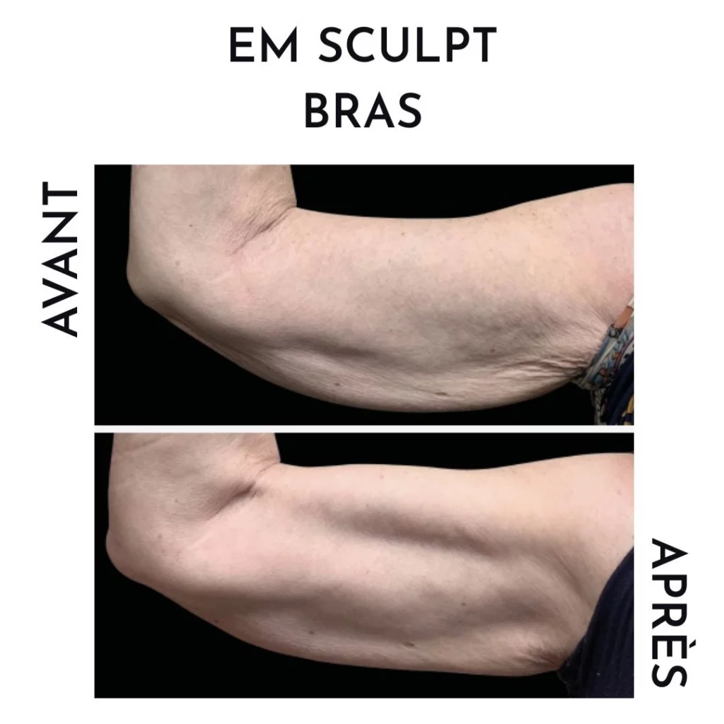 résultat avant/après em sculpt bras