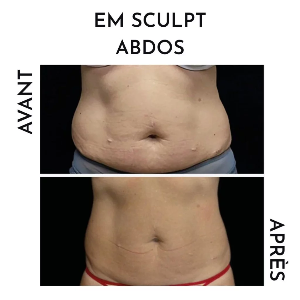 résultat avant/après em sculpt abdos