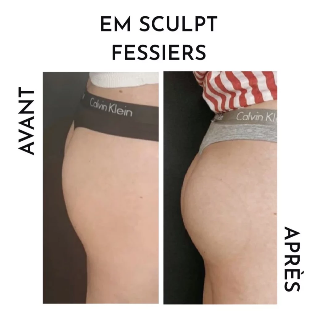 résultat avant/après em sculpt fessiers