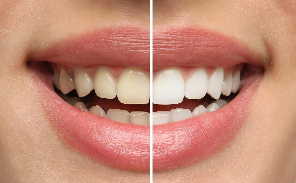 ToothWhitening1
