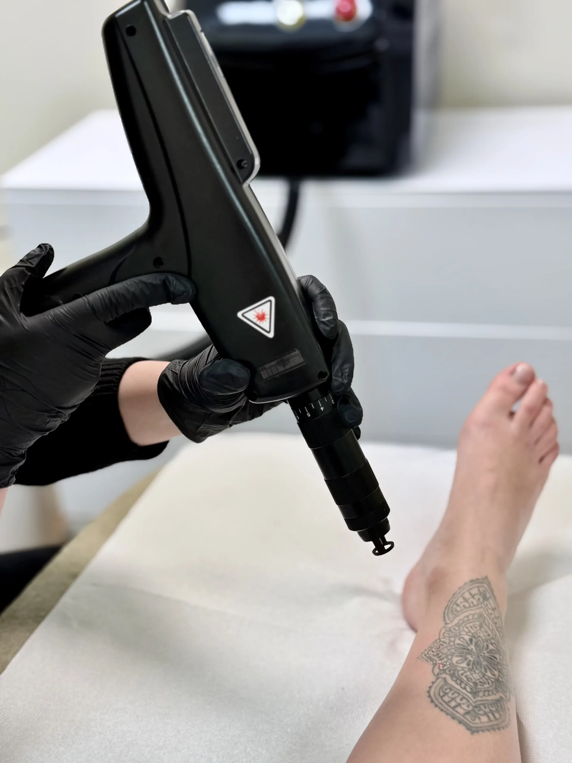 Séance de détatouage laser Picoseconde A'Corps Beauté