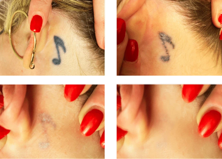 Tatouage note de musique derrière l'oreille avant détatouage laser à Nancy