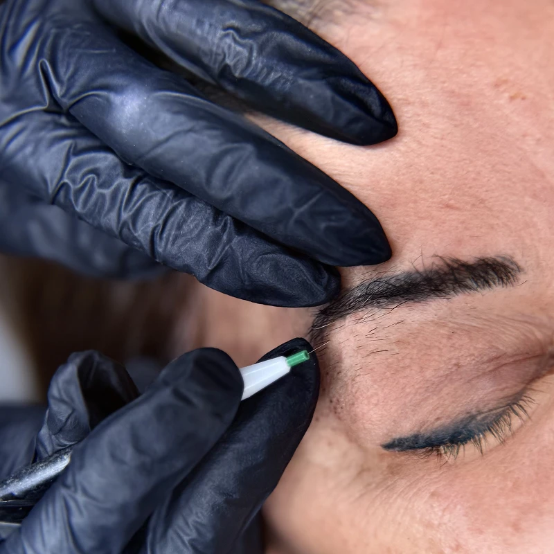 Électrolyse chez A'Corps Beauté - Nancy et Metz