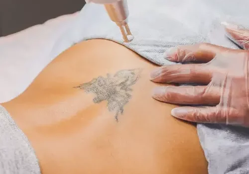 détatouage IPL 5 détatouage IPL 5
